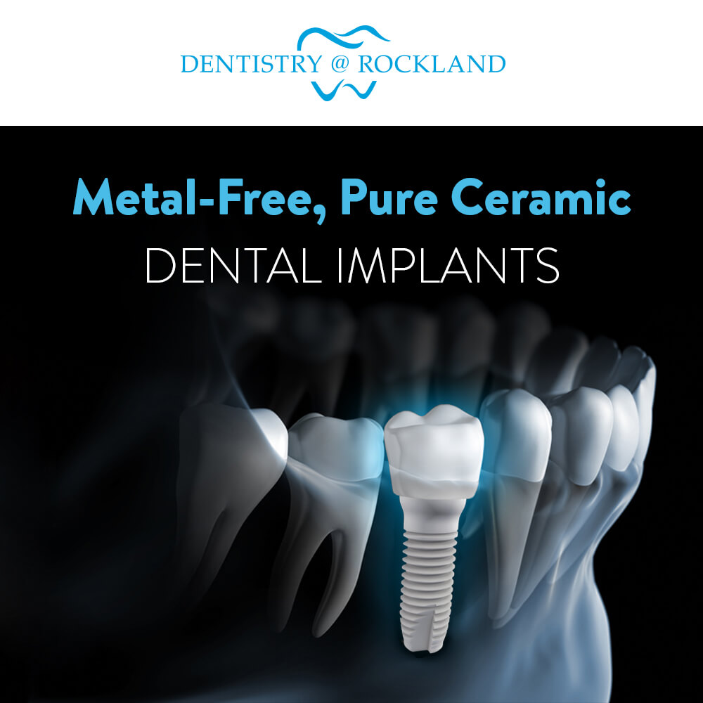 Ceramic Dental Implants Rockland