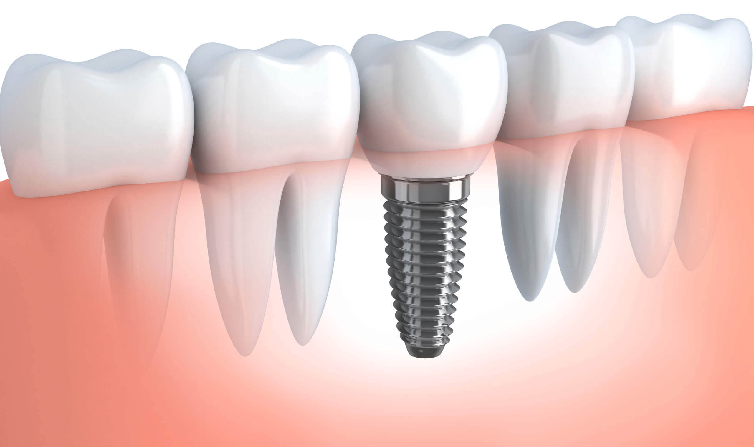 Dental Implant Rockland Ontario